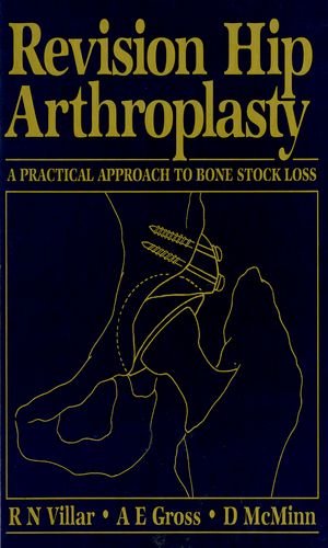 Revision Hip Arthroplasty: A Practical Approach to Bone Stock Loss