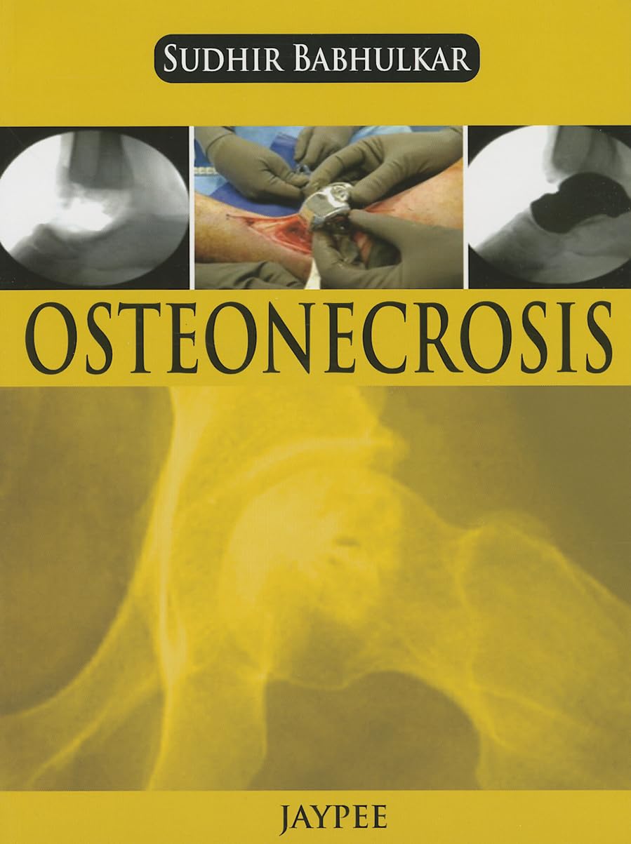 OSTEONECROSIS