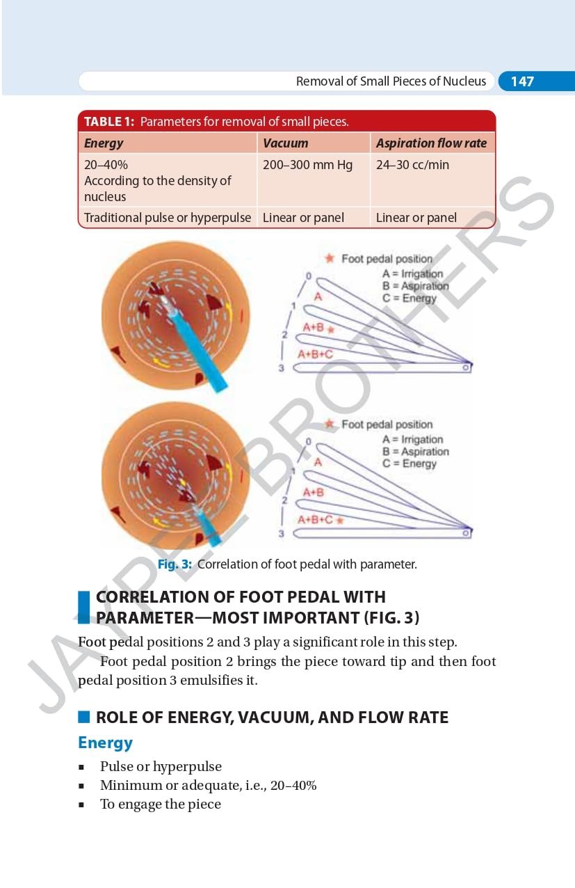 SIMPLIFIED PHACOEMULSIFICATION