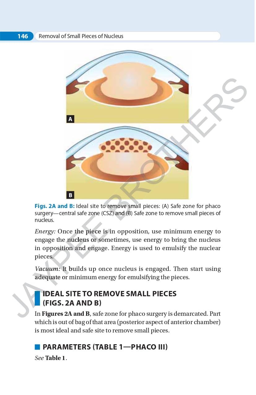 SIMPLIFIED PHACOEMULSIFICATION