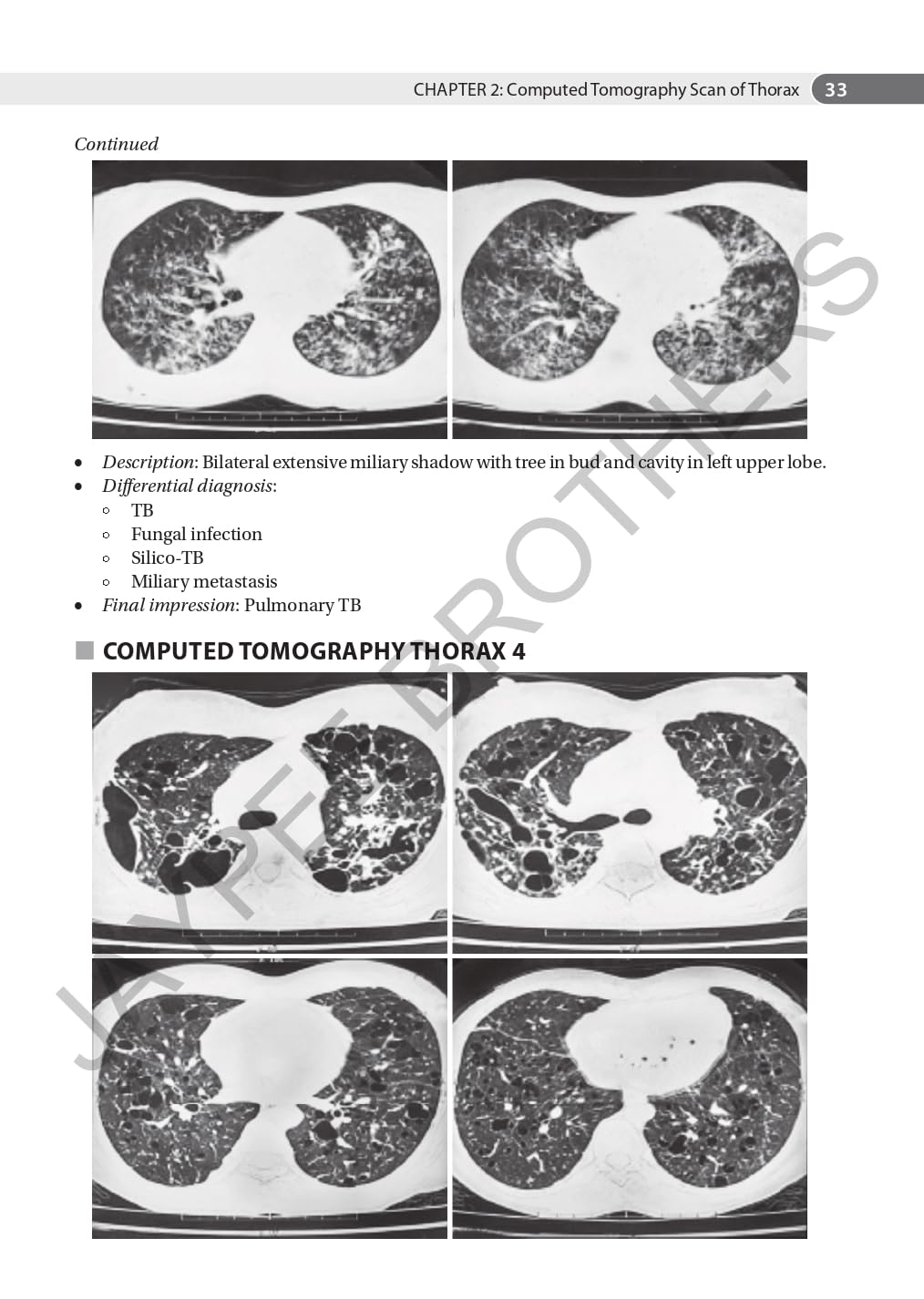AN AID TO RESPIRATORY MEDICINE FOR POSTGRADUATE EXIT EXAM (MD, DNB AND DIPLOMA)