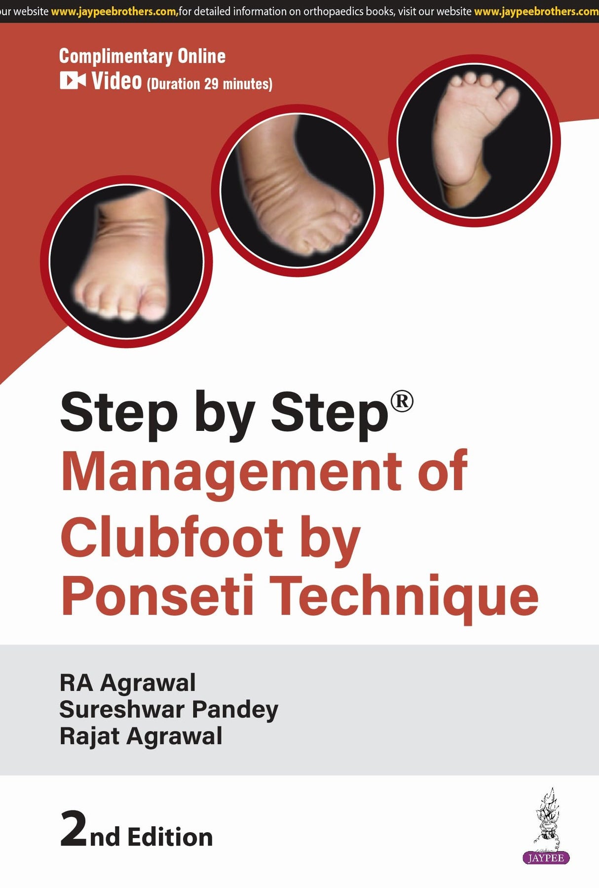 STEP BY STEP MANAGEMENT OF CLUBFOOT BY PONSETI TECHNIQUE