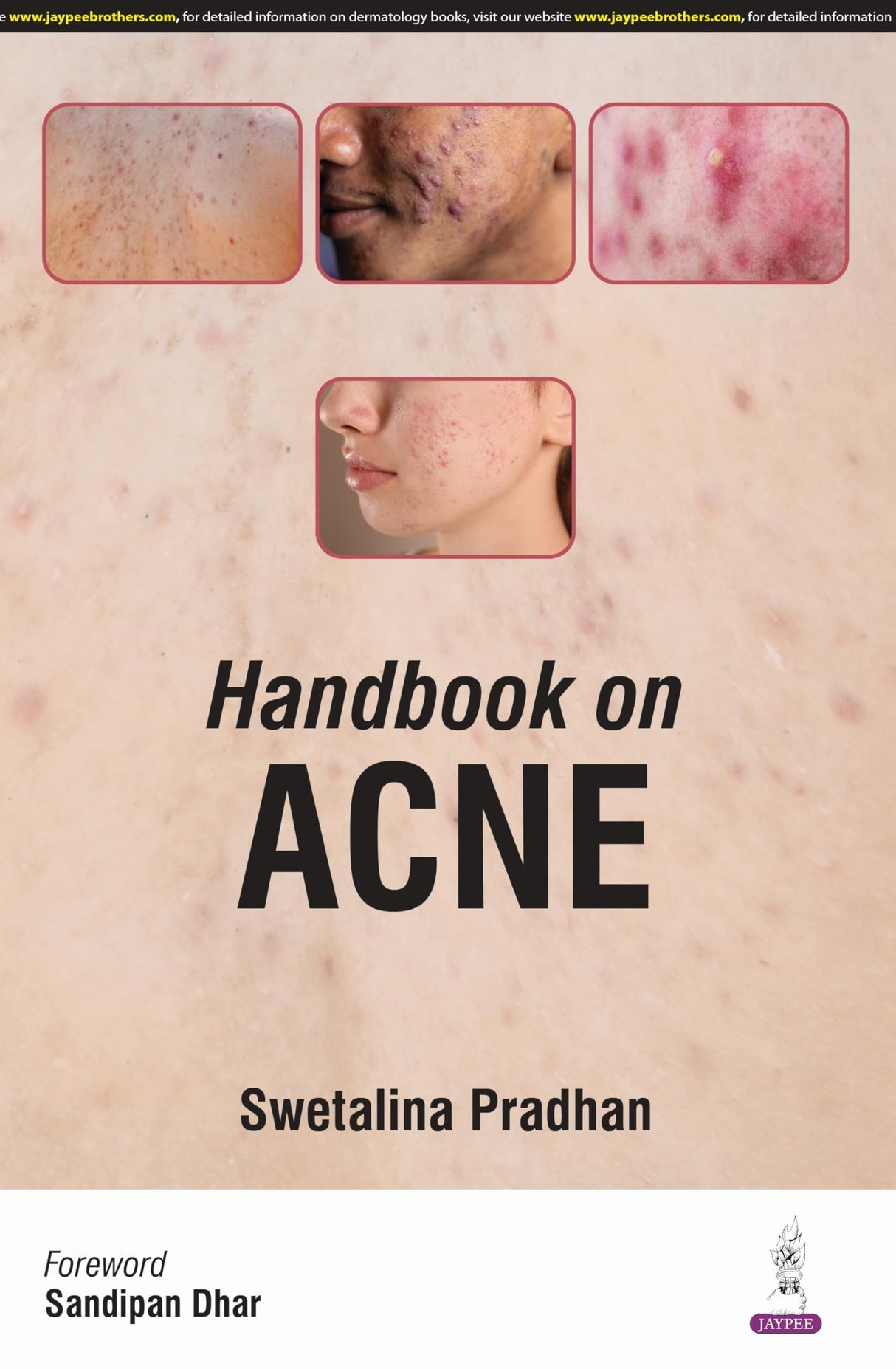 HANDBOOK ON ACNE