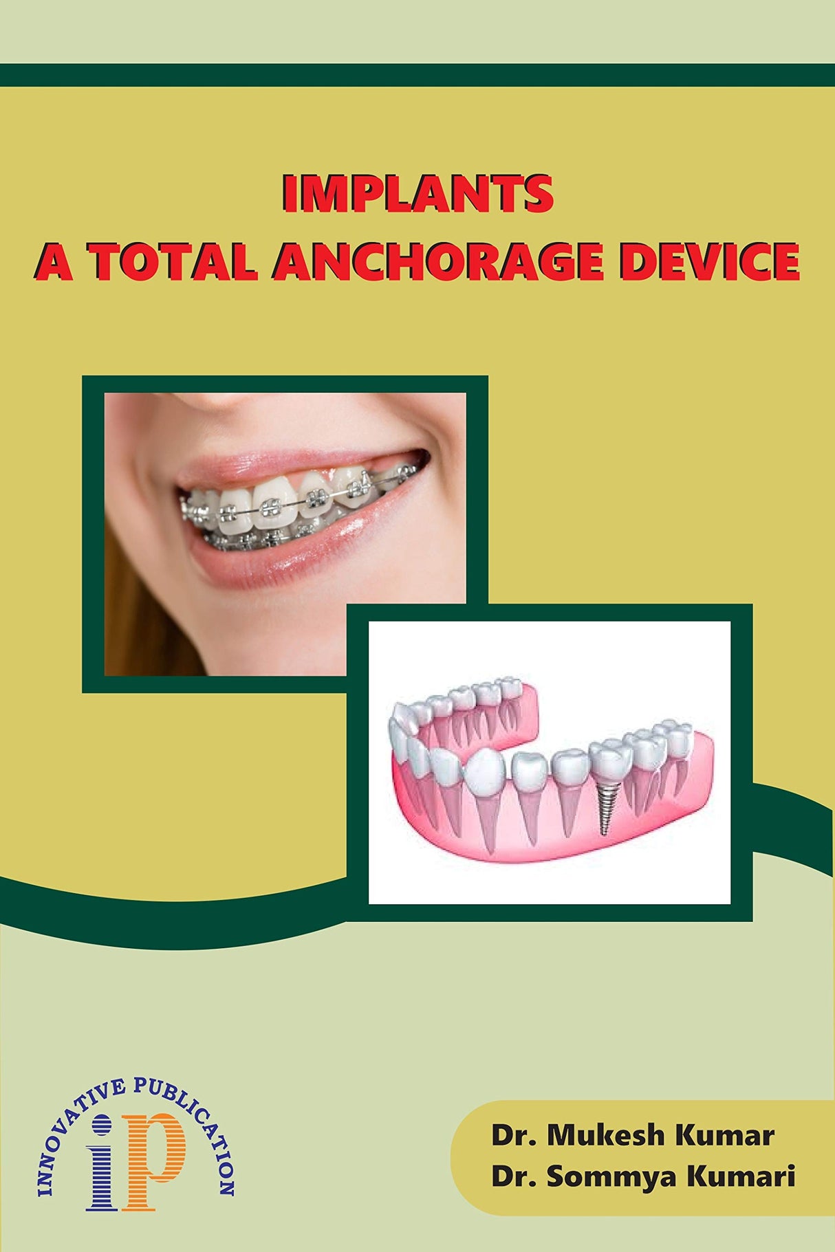 Implants - A Total Anchorage Device
