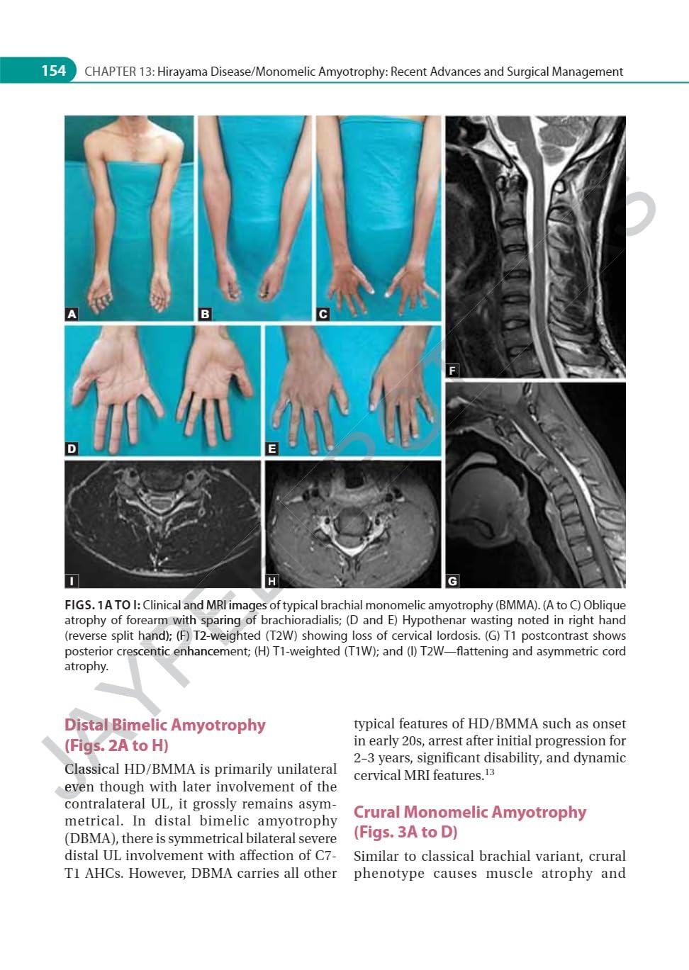 IAN ADVANCES IN NEUROMUSCULAR DISORDERS