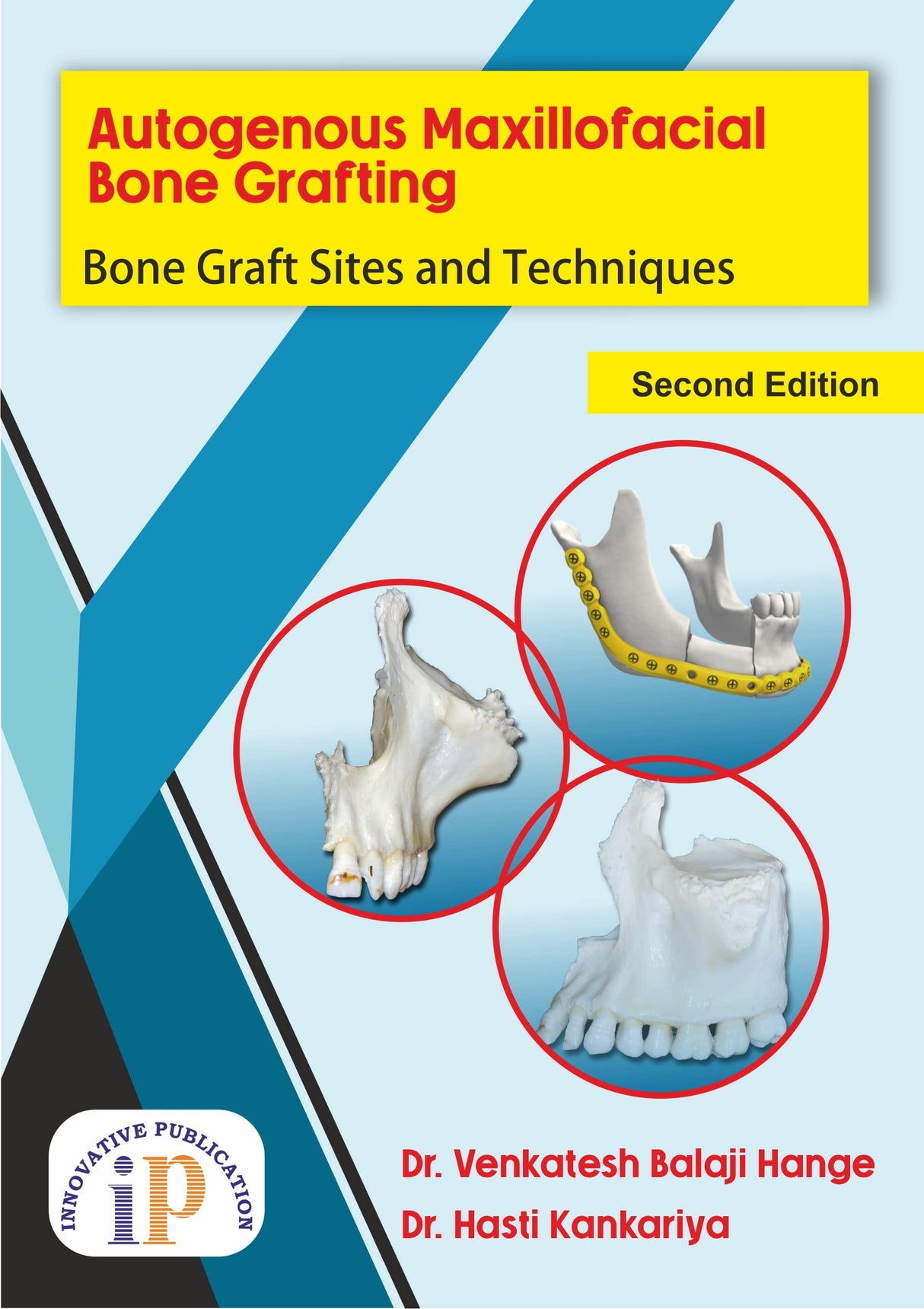 Autogenous Maxillofacial Bone Grafting: Bone Graft Sites and Techniques