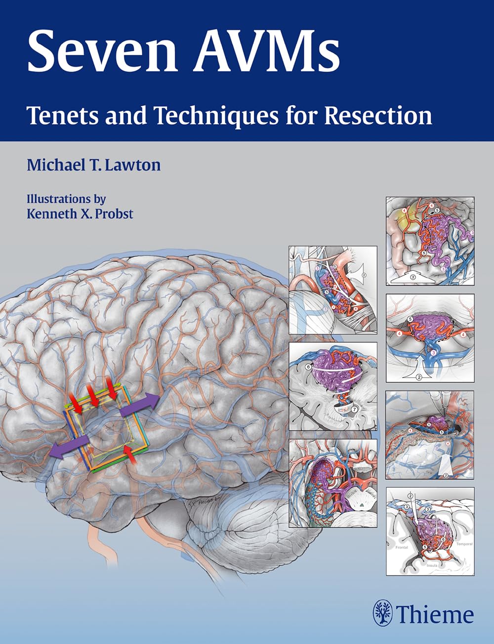 Seven AVMs: Tenets and Techniques for Resection - Retail Maharaj