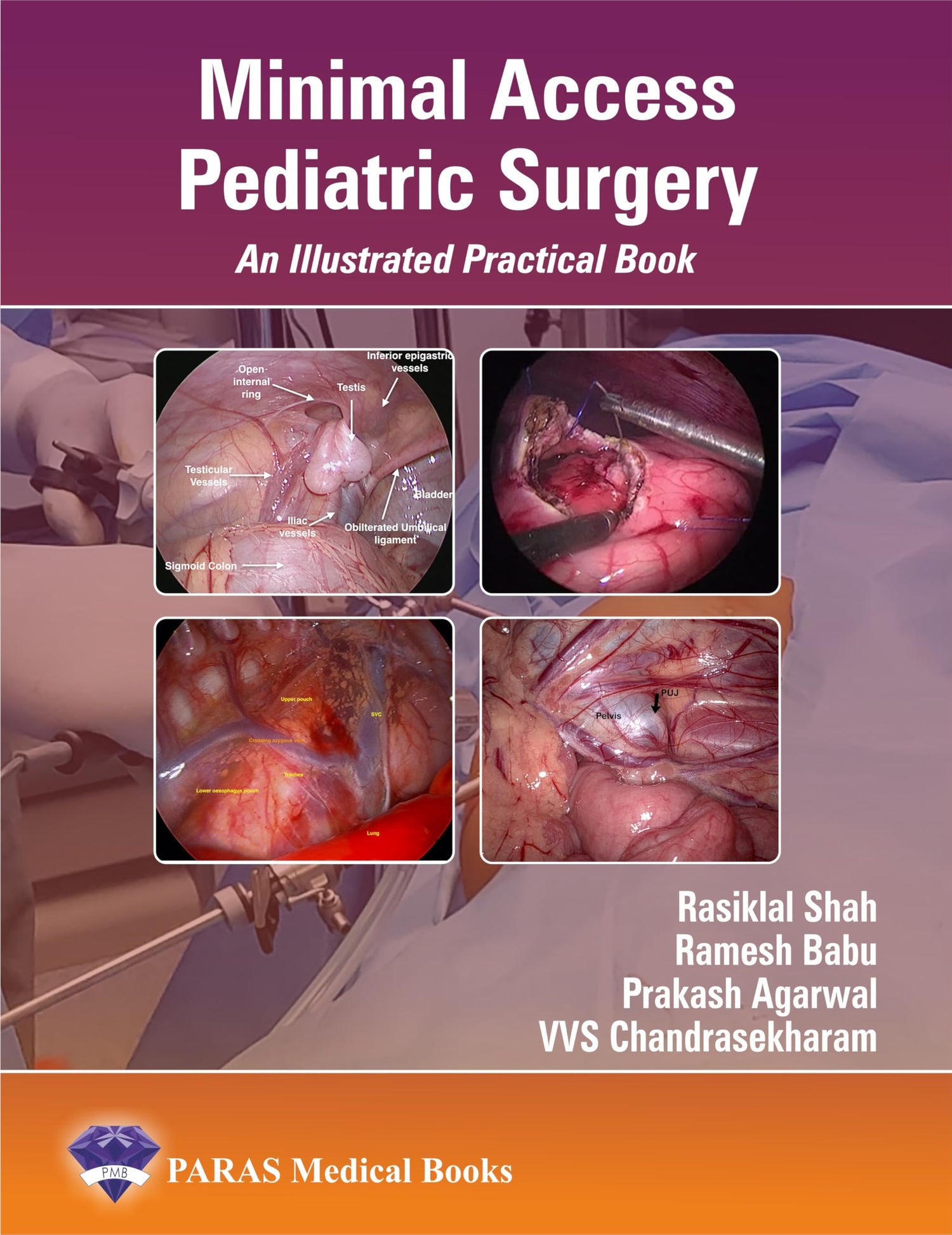 Minimal Access Pediatric Surgery
