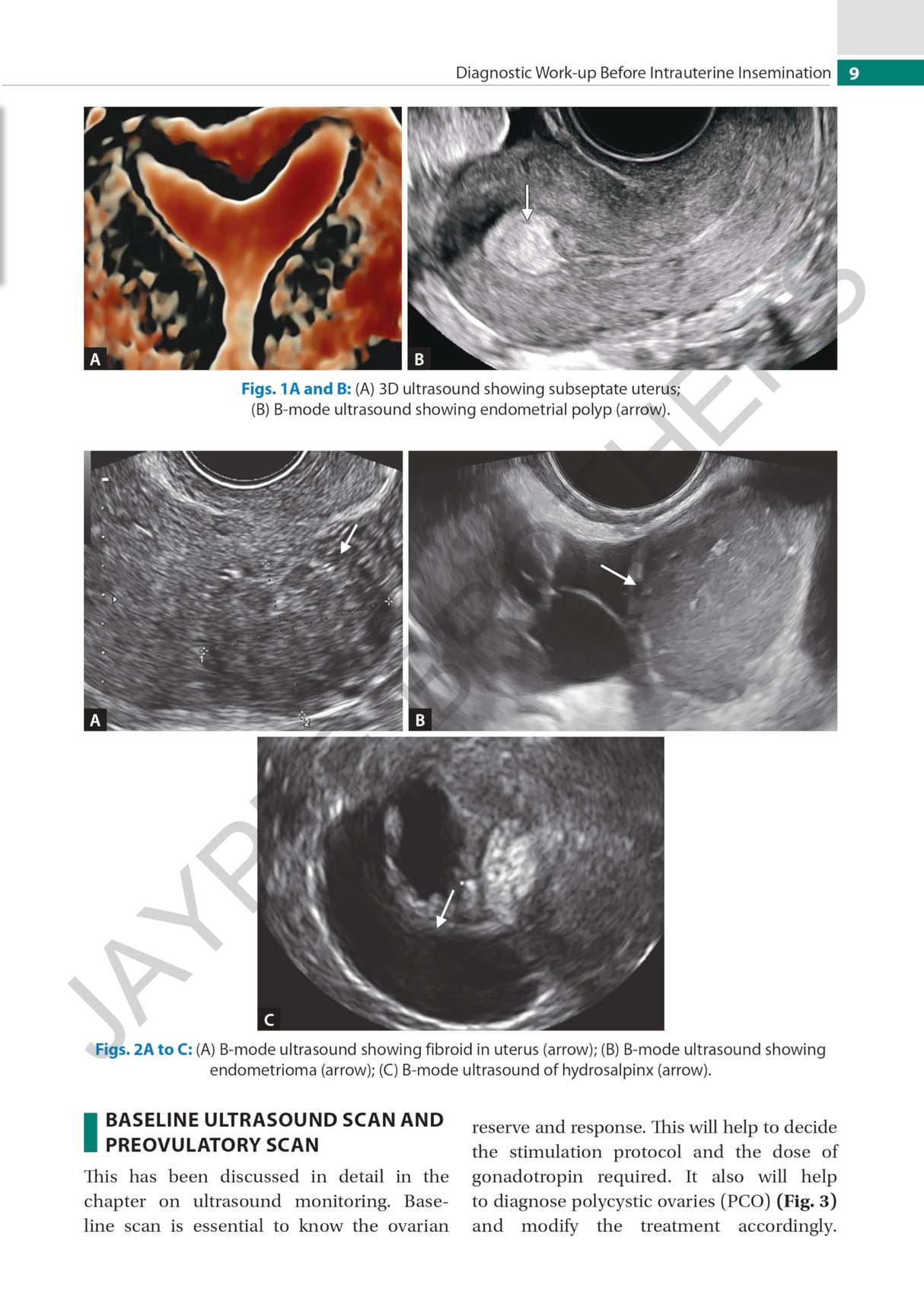 PRACTICAL GUIDE TO INTRAUTERINE INSEMINATION (IUI)