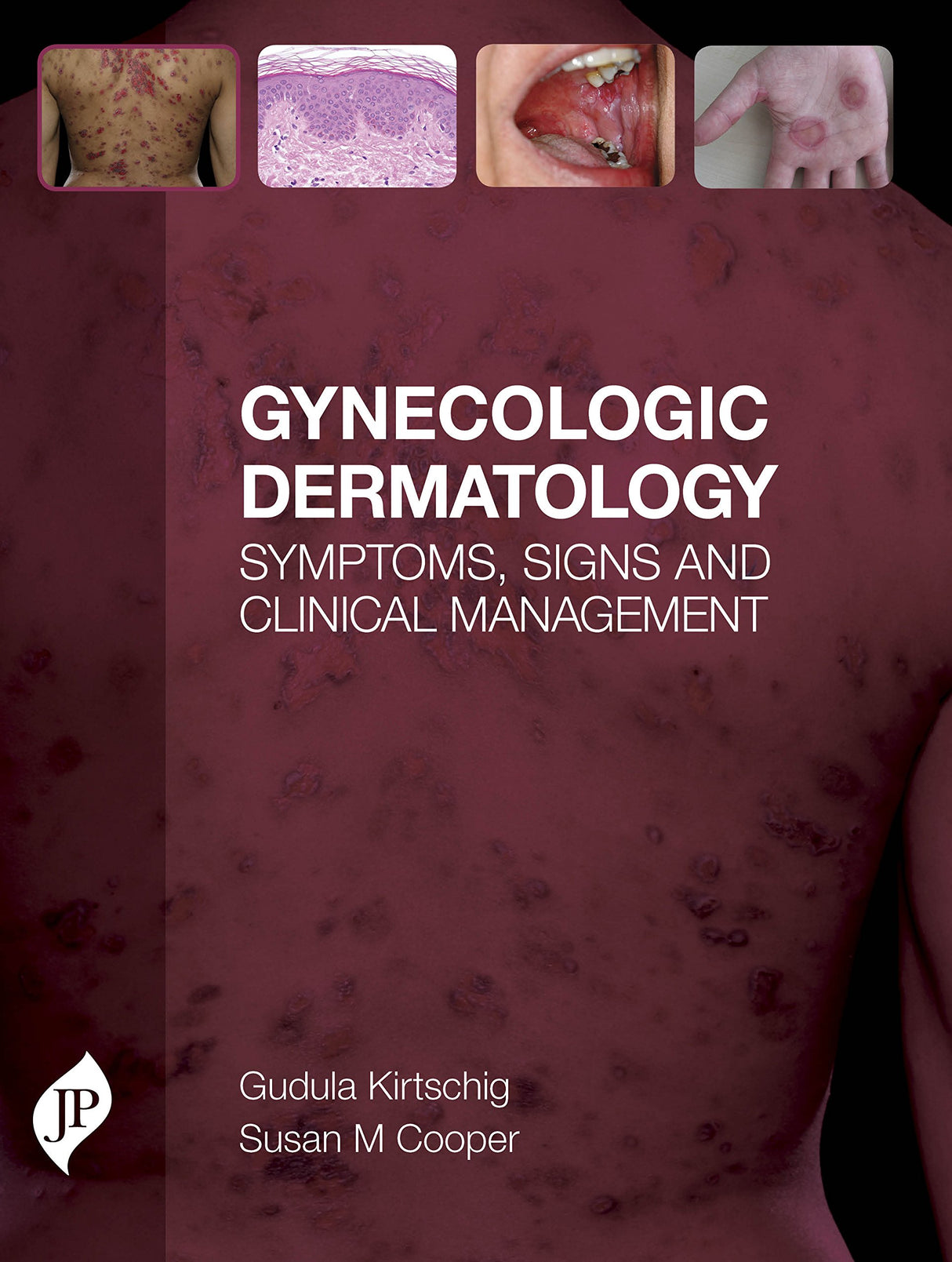 GYNECOLOGIC DERMATOLOGY SYMPTOMS, SIGNS AND CLINICAL MANAGEMENT