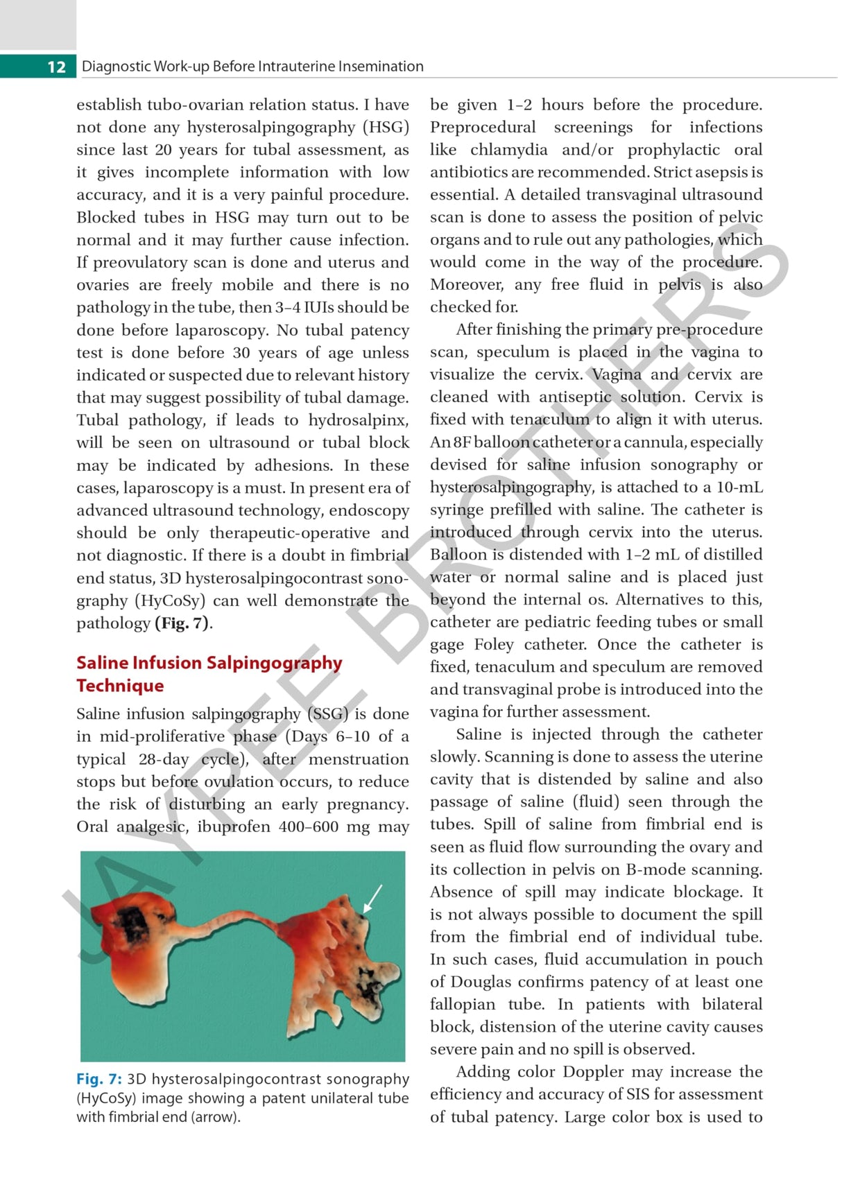 PRACTICAL GUIDE TO INTRAUTERINE INSEMINATION (IUI)