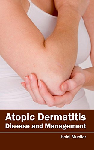 Atopic Dermatitis: Disease and Management - Retail Maharaj