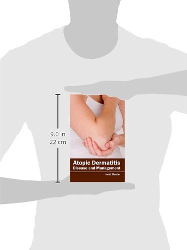 Atopic Dermatitis: Disease and Management - Retail Maharaj