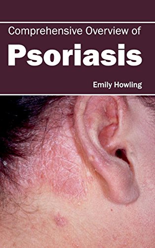 Comprehensive Overview of Psoriasis - Retail Maharaj