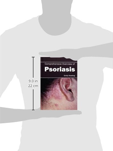 Comprehensive Overview of Psoriasis - Retail Maharaj