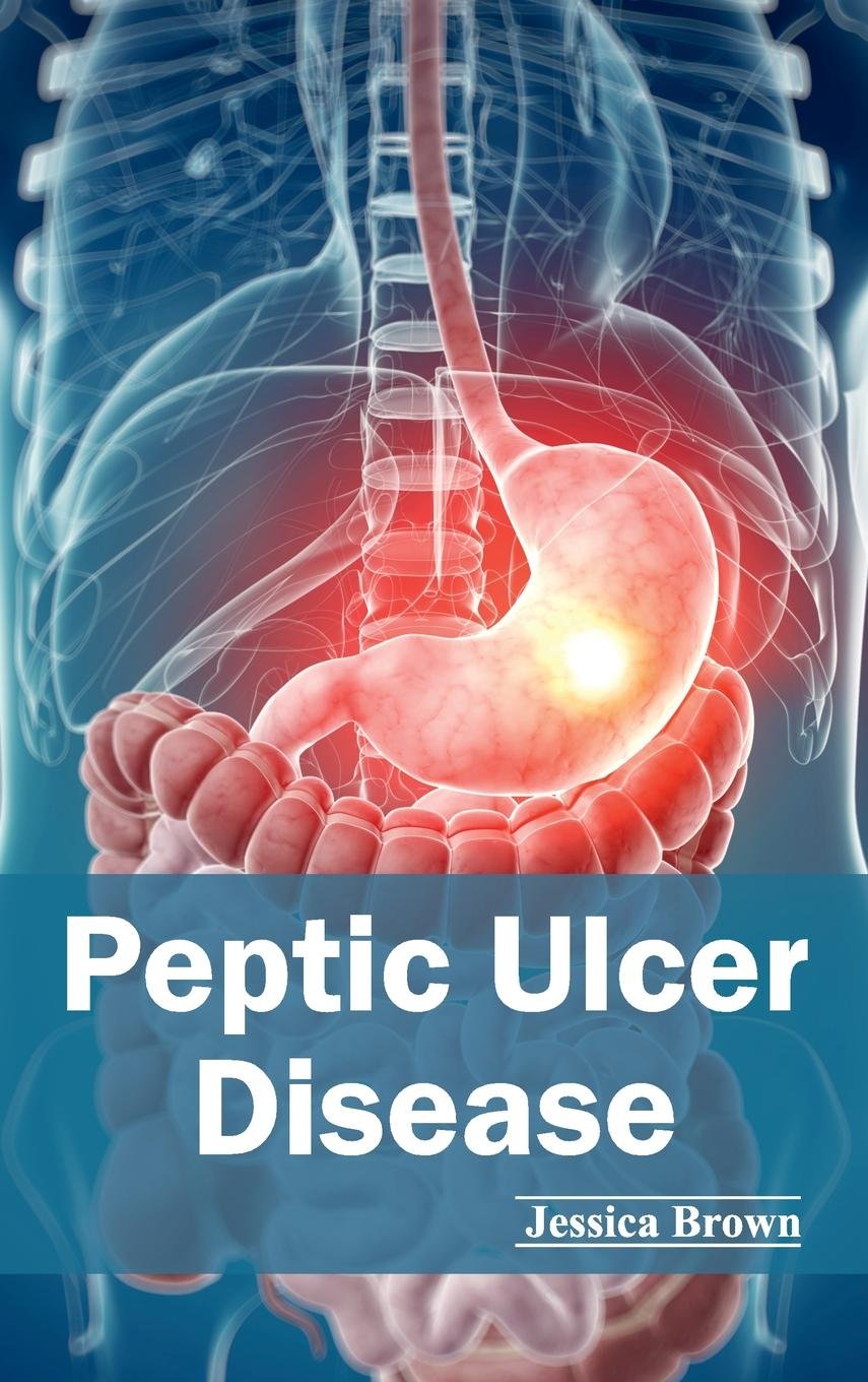 PEPTIC ULCER DISEASE - Retail Maharaj