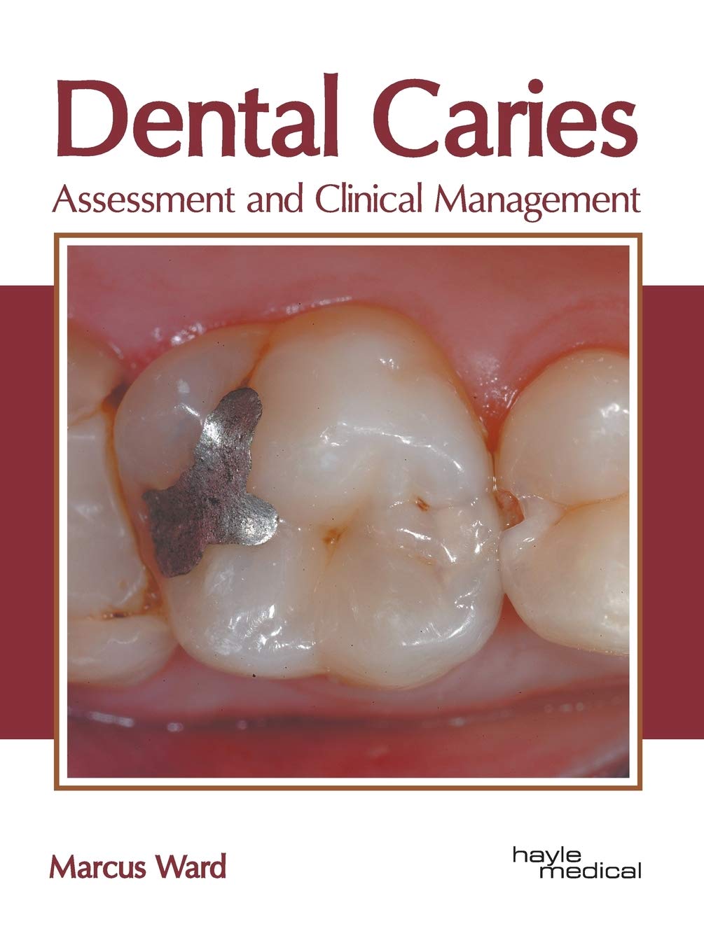 Dental Caries: Assessment and Clinical Management - Retail Maharaj