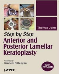 STEP BY STEP ANTERIOR AND POSTERIOR LAMELLAR KERATOPLASTY(WITH DVD)
