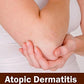 Atopic Dermatitis: Disease and Management