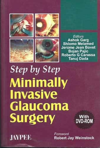 Step By Step Minimally invasive Glaucoma Surgery with DVD-ROM