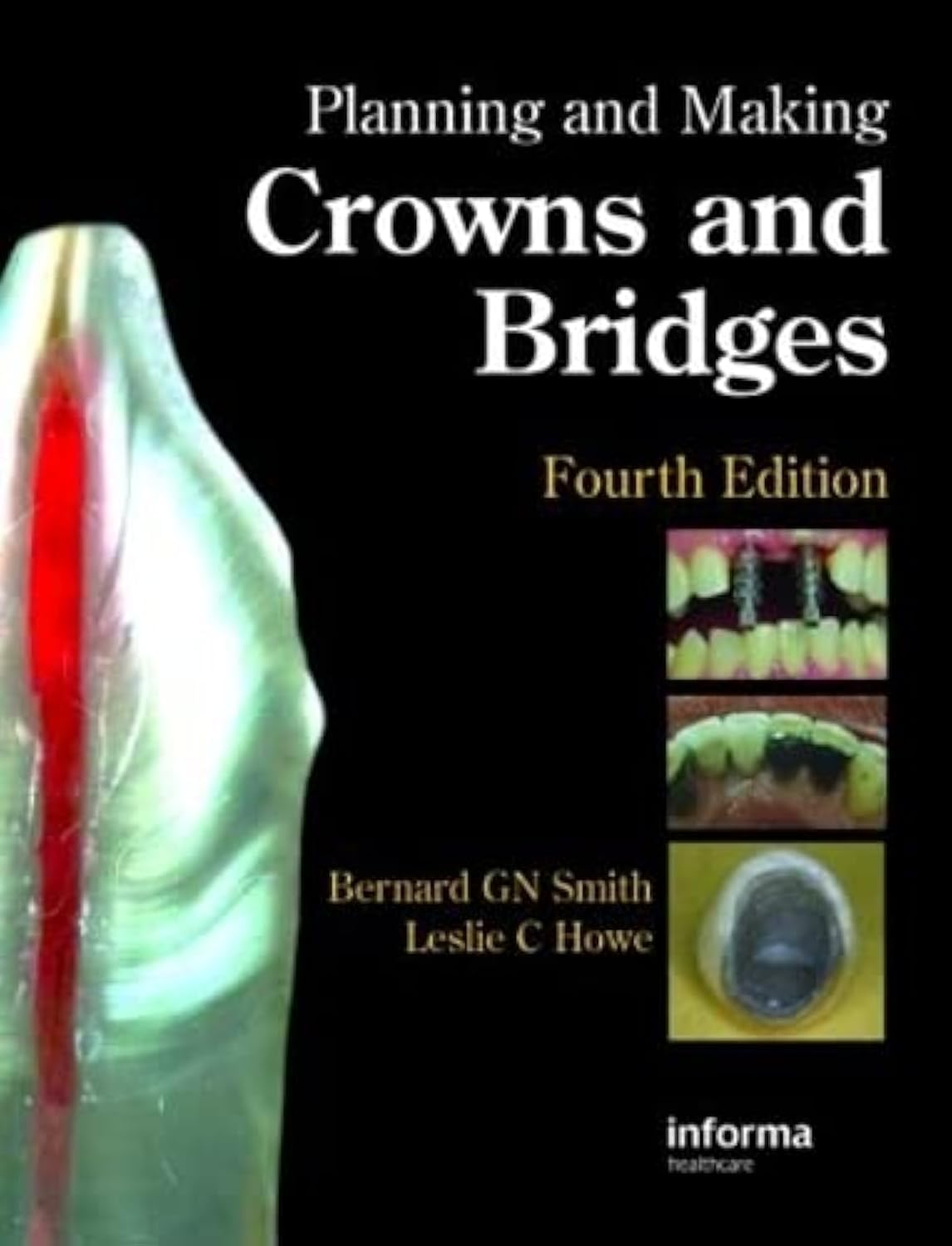 (EX)PLANNING AND MAKING CROWNS AND BRIDGES