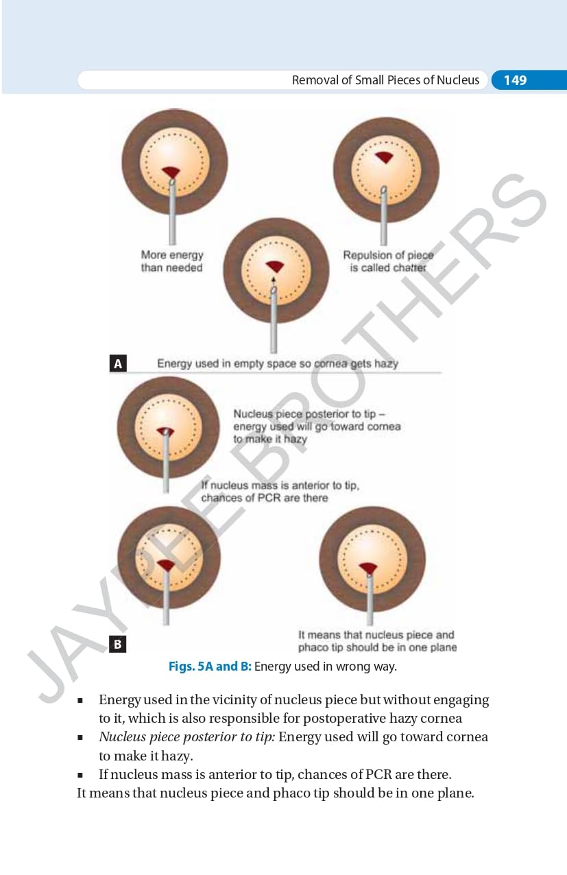 SIMPLIFIED PHACOEMULSIFICATION