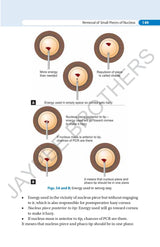 SIMPLIFIED PHACOEMULSIFICATION
