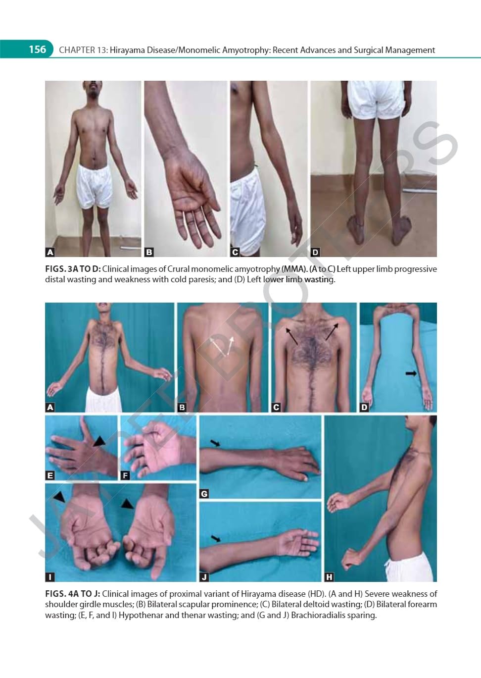 IAN ADVANCES IN NEUROMUSCULAR DISORDERS