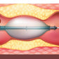 Interventional Cardiology: Research and Practice