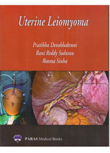 Uterine Leiomyoma 1st Ed. 2019