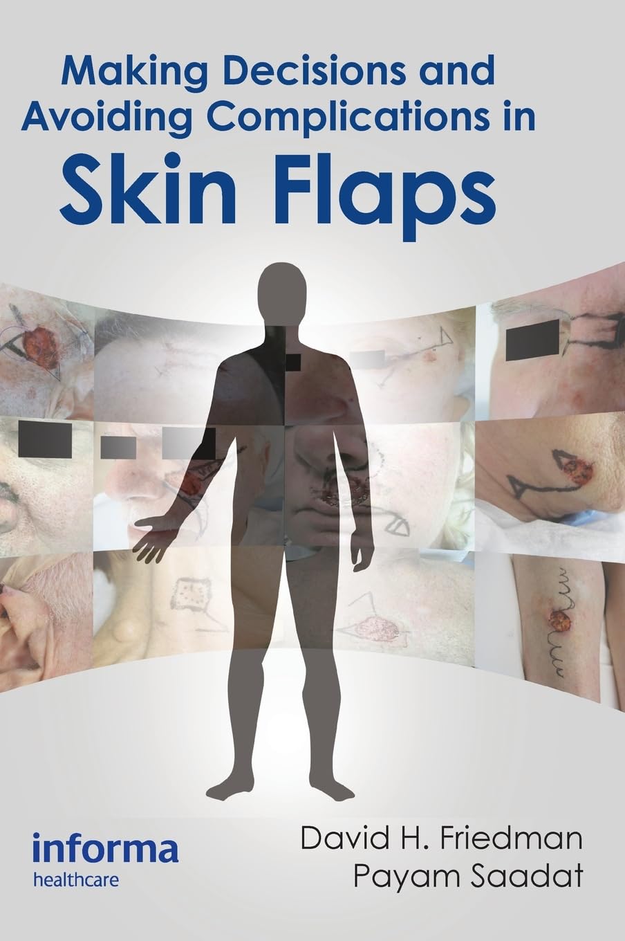 Making Decisions And Avoiding Complications In Skin Flaps (Ex)