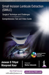 SMALL INCISION LENTICULE EXTRACTION (SMILE) SURGICAL TECHNIQUE AND CHALLENGES:COMPREHENSIVE TEXT