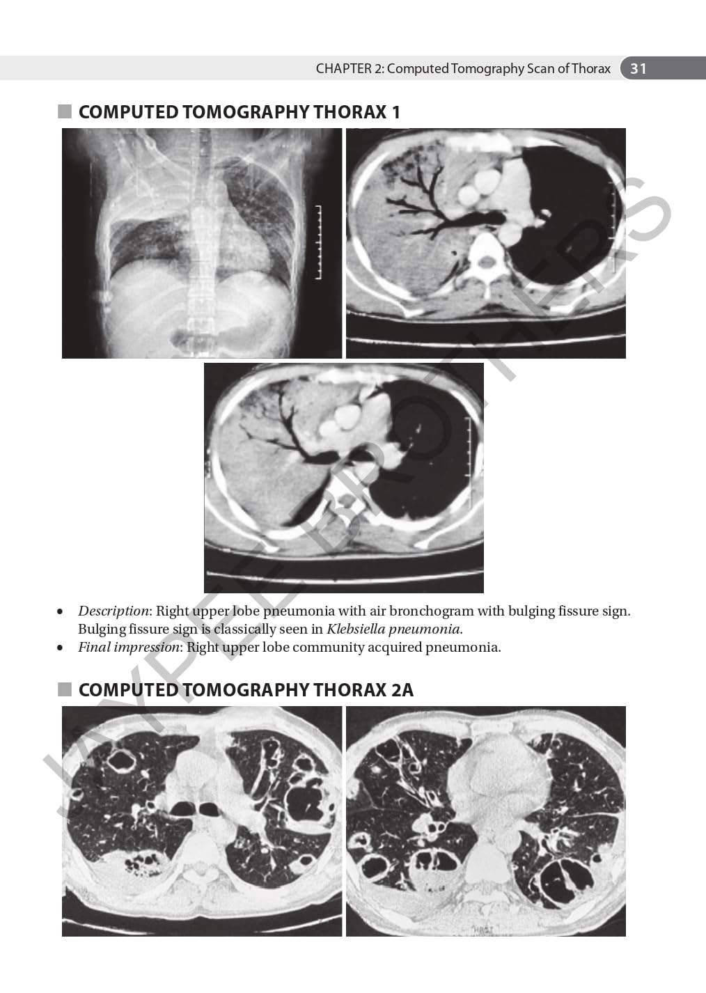 AN AID TO RESPIRATORY MEDICINE FOR POSTGRADUATE EXIT EXAM (MD, DNB AND DIPLOMA)