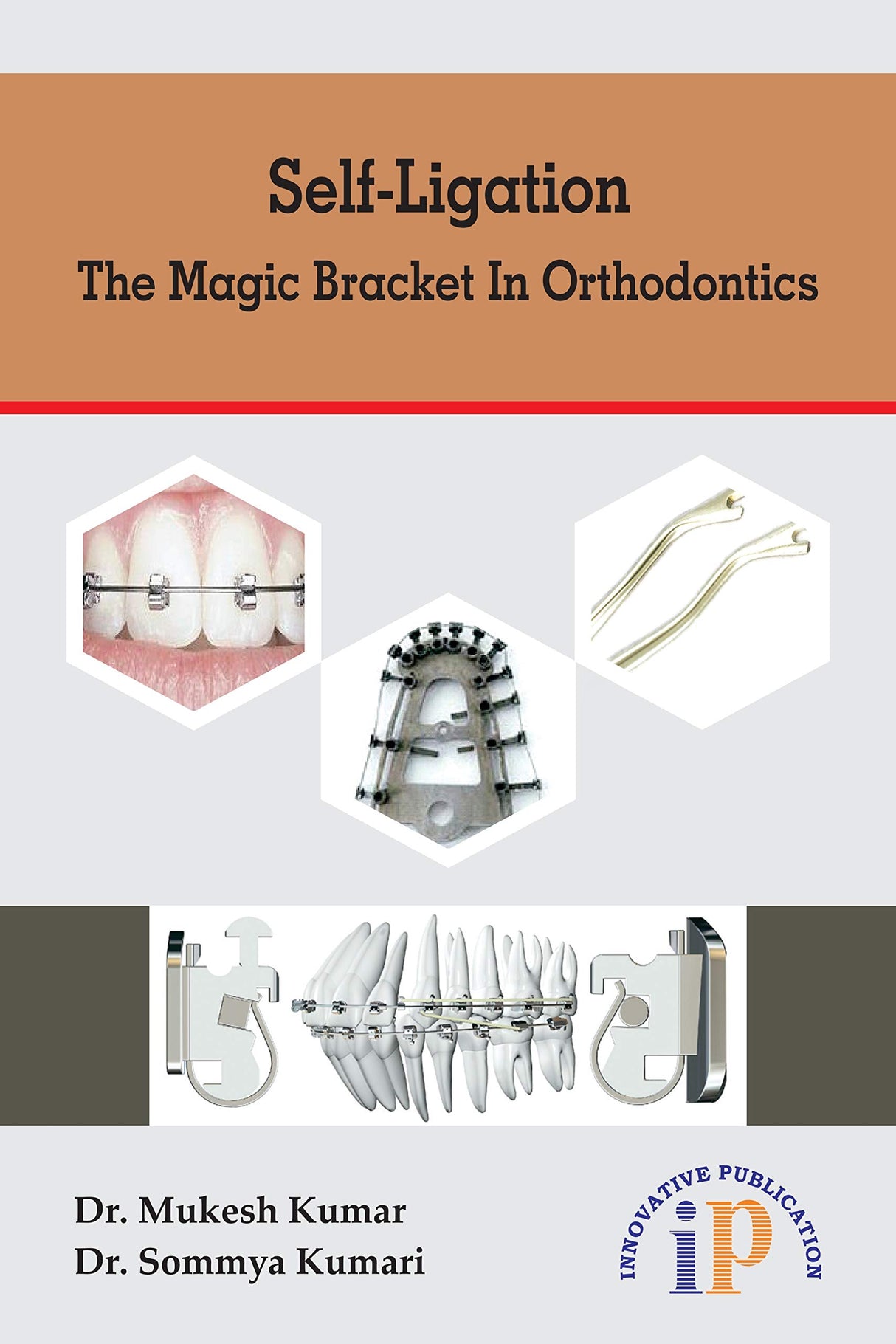 Self-Ligation - The Magic Bracket In Orthodontics