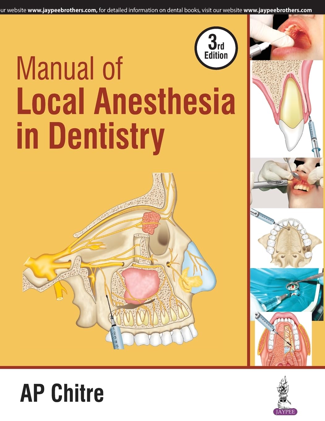 MANUAL OF LOCAL ANESTHESIA IN DENTISTRY