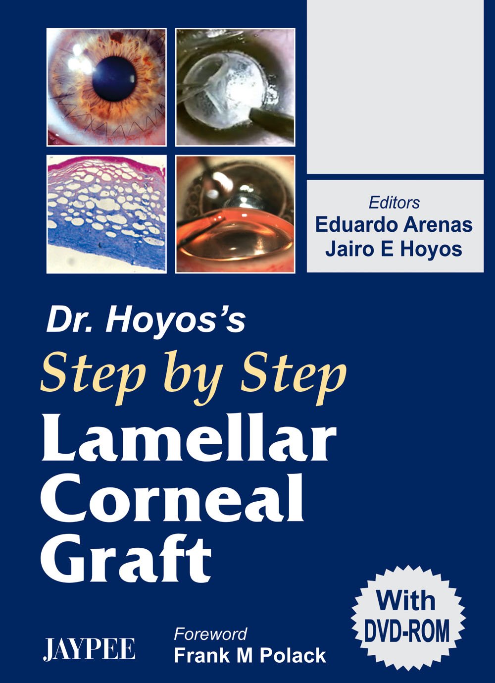 Dr.Hoyos' Step By Step Lamellar Corneal Graft With Dvd-Rom