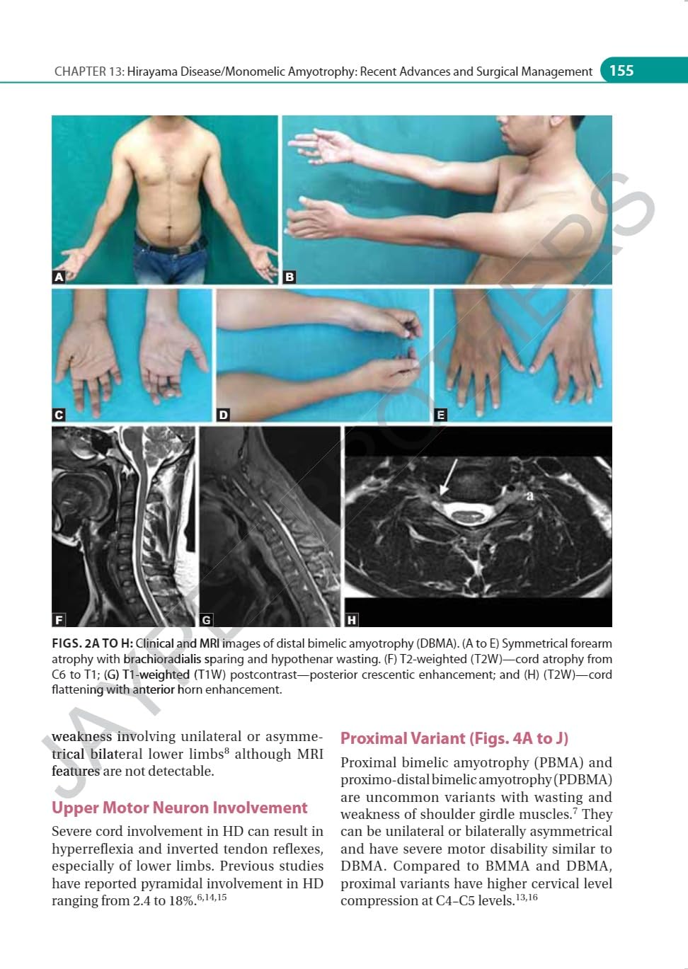 IAN ADVANCES IN NEUROMUSCULAR DISORDERS