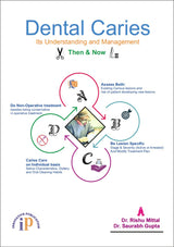 Dental Caries (Its Understanding and Management) Then & Now
