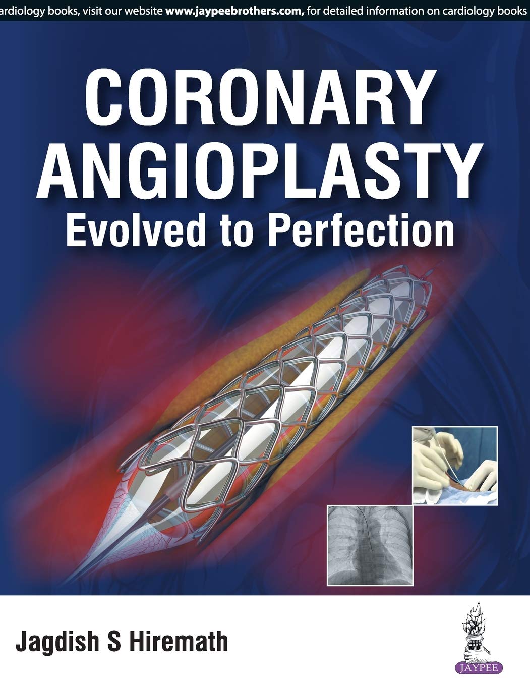 CORONARY ANGIOPLASTY EVOLVED TO PERFECTION