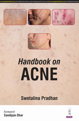 HANDBOOK ON ACNE