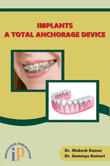 Implants - A Total Anchorage Device