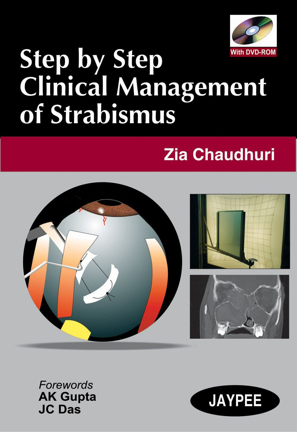 STEP BY STEP CLINICAL MANAGEMENT OF STRABISMUS WITH DVD-ROM