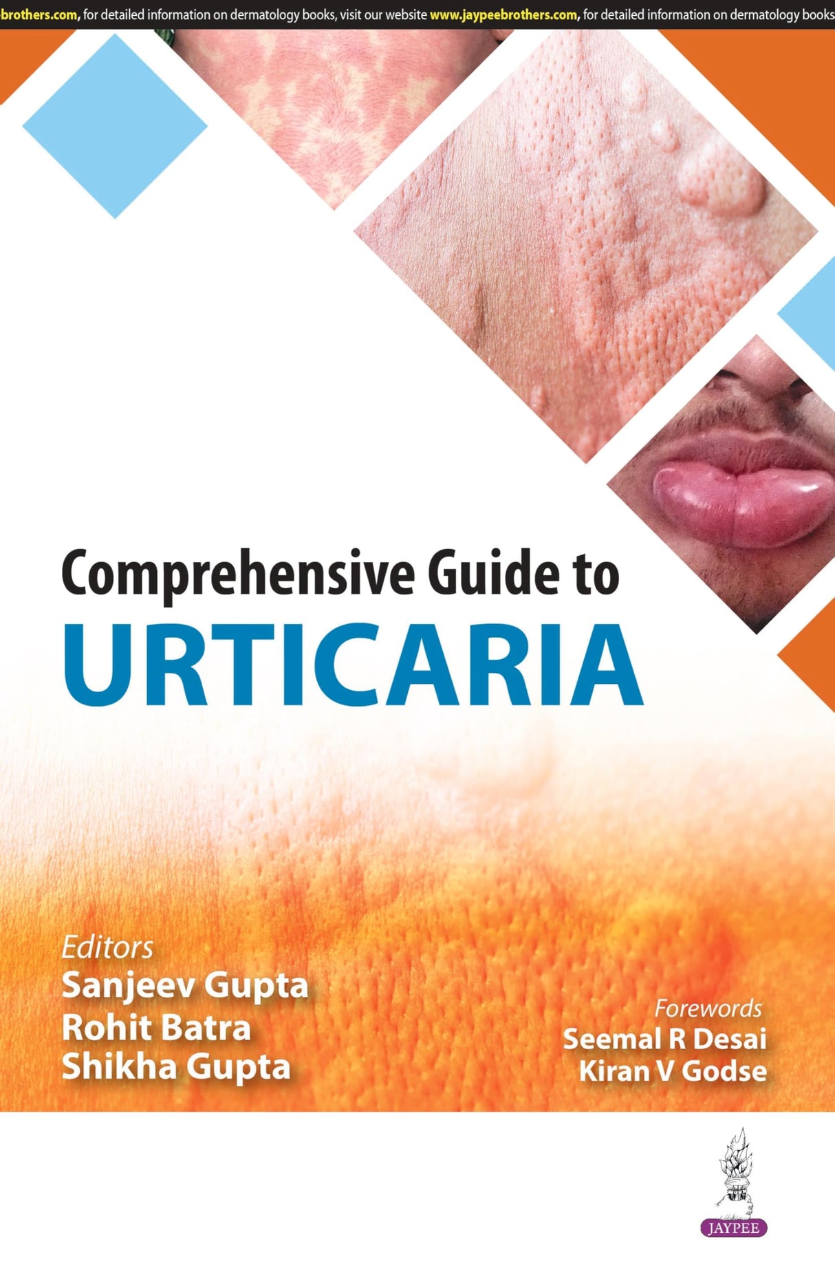 COMPREHENSIVE GUIDE TO URTICARIA