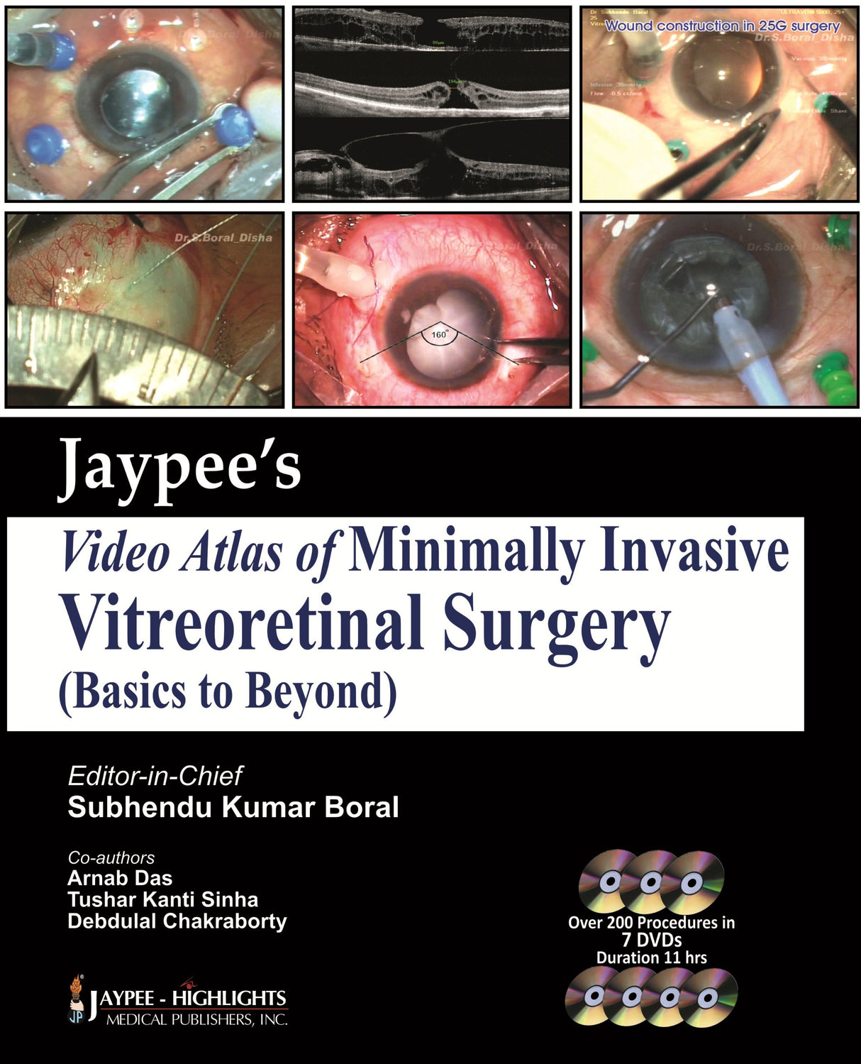 Jaypee Video Atlas Of Minimally Invasive Vitreoretinal Surgery