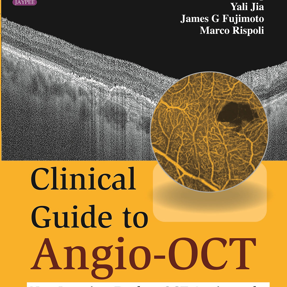 CLINICAL GUIDE TO ANGIO-OCT: NON INVASIVE,DYELESS OCT ANGIOGRAPHY