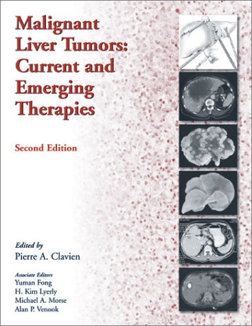 Malignant Liver Tumors: Current and Emerging Therapies - Retail Maharaj