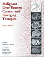 Malignant Liver Tumors: Current and Emerging Therapies - Retail Maharaj